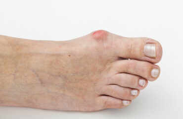 epitact hallux valgus oignon orthèse corrective 2 Alexandre Hryb - etiopathe Cogolin - Saint Tropez - Sainte Maxime - Le Lavandou - La Londe.jpg