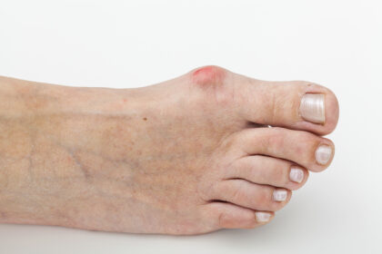 epitact hallux valgus oignon orthèse corrective 2 Alexandre Hryb – etiopathe Cogolin – Saint Tropez – Sainte Maxime – Le Lavandou – La Londe.jpg epitact hallux valgus oignon orthèse corrective 2 Alexandre Hryb - etiopathe Cogolin - Saint Tropez - Sainte Maxime - Le Lavandou - La Londe.jpg