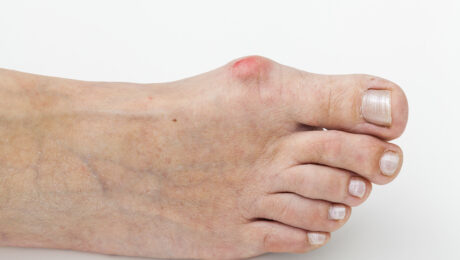 epitact hallux valgus oignon orthèse corrective 2 Alexandre Hryb - etiopathe Cogolin - Saint Tropez - Sainte Maxime - Le Lavandou - La Londe.jpg