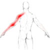 Névralgie cervico-brachiale, douleur bras, douleur cervicale