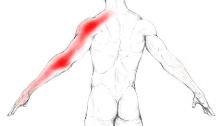 Névralgie cervico-brachiale, douleur bras, douleur cervicale